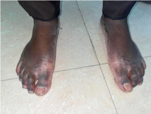Extra oral image – Right foot dorsal surface