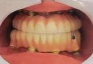 Intraoral image after final prosthesis placement 