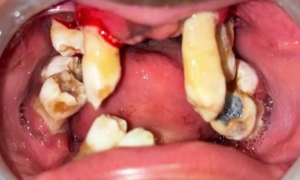 Preoperative Intra-oral image 