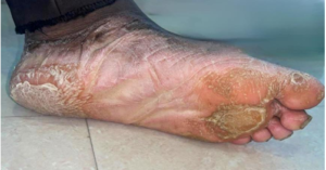 Extraoral image – Left foot dorsal surface 