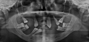 Preoperative OPG