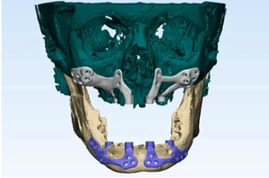 Figure 3b: Customized subperiosteal implants designed virtually 3D virtual bone model 