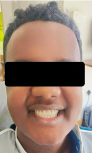 Smile after final prosthesis placement 