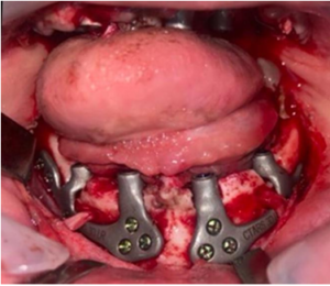 Intraoperative image 