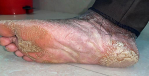 Extra oral image – Right foot dorsal surface
