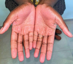 Extraoral image – Palms 