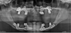 Post-operative OPG after placement of implants