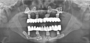 Postoperative OPG after final prosthesis placement